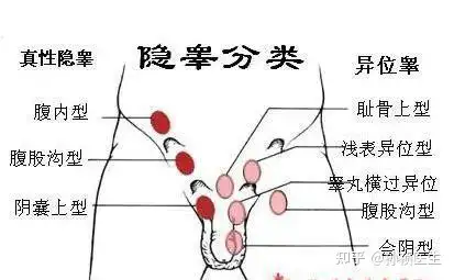 发现孩子的阴囊里面是空的小心可能是隐睾