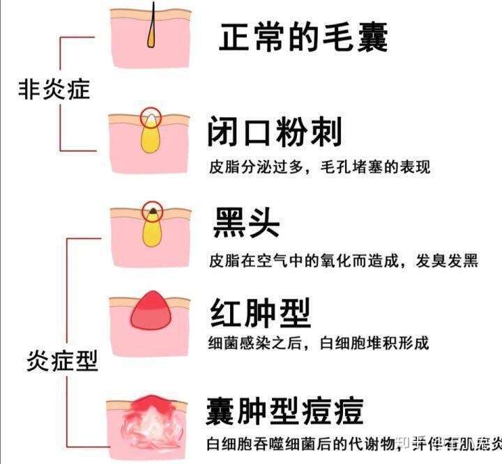 跪求一个可以祛痘痘的产品(要有实际效果的?