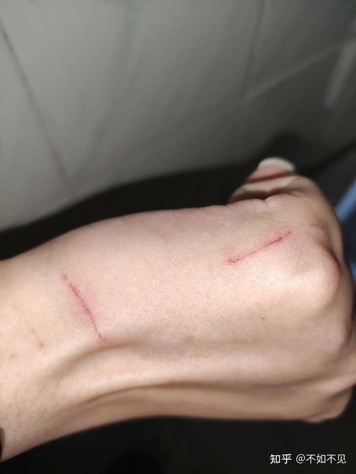 被我家猫猫抓伤第4天,当时宠物店医生告诉我不用打针,但是现在被家人