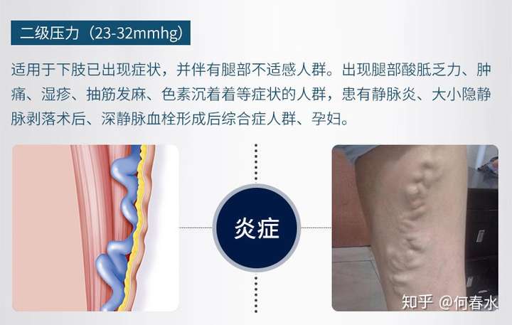 為什麼穿上彈力襪後感覺靜脈曲張更嚴重了