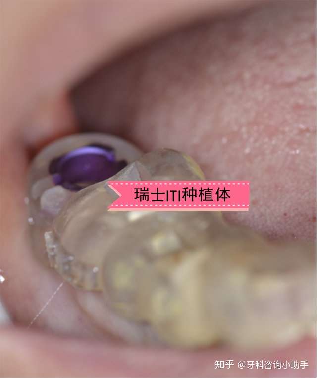 北京种植牙案例分享瑞士iti种植体两颗磨牙种植