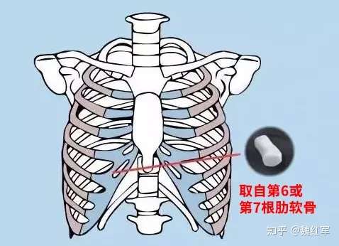 魏红军 半肋骨or全肋骨隆鼻那个效果好 知乎