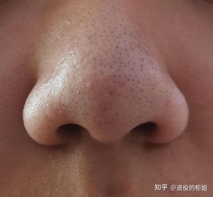 求助知友,这样的黑头怎么去除?可以用水杨酸吗?