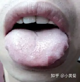 一份红一份热——"点刺舌"舌象