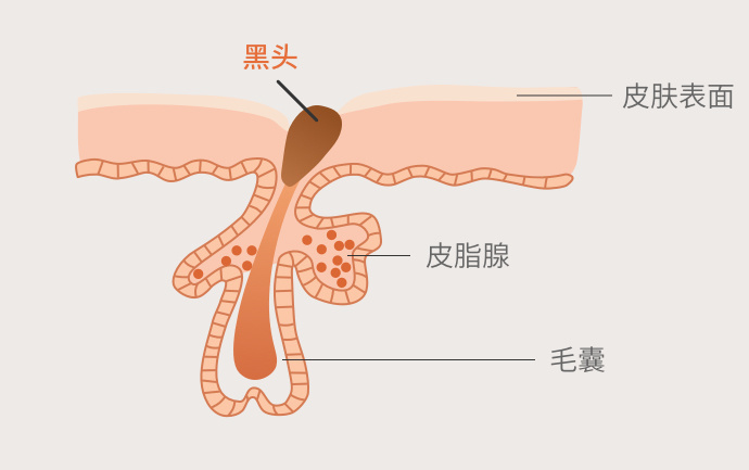 臉頰和鼻子上的黑頭粉刺到底應不應該擠?