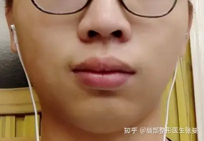 唇珠平了怎么办