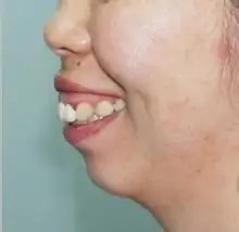 羡慕别人的瓜子脸我却下巴都没天包地惹的祸