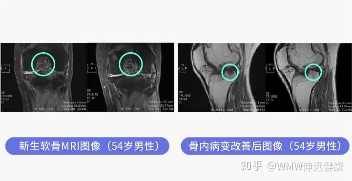 日本干细胞治疗骨关节炎方案 知乎