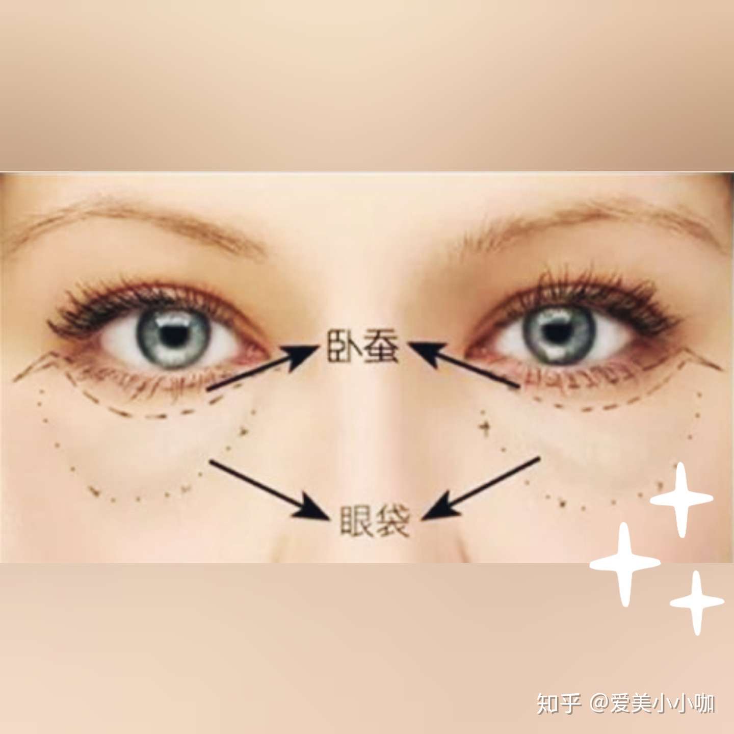 卧蚕和眼袋怎么区别 知乎