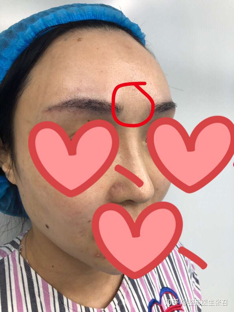 整形医生张召 的想法: #眉心凹陷# 前三张术前,后面为眉心填充