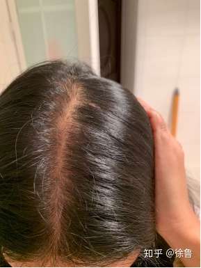 23岁女生狂脱发,怎么能快速生发?