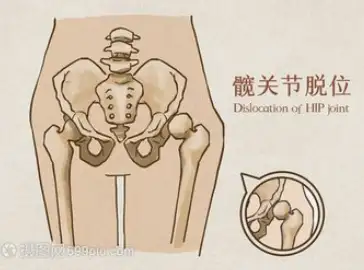 髋关节前脱位有哪些诱发因素?