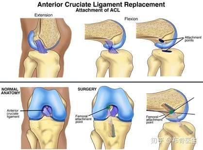 布骨告诉你 Acl重建术后康复最全面 最详细方案 前期 知乎