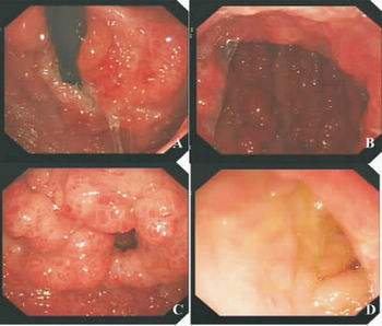 (胃鏡視角:a: 賁門和胃底; b: 胃體; c: 胃竇; d: 十二指腸)