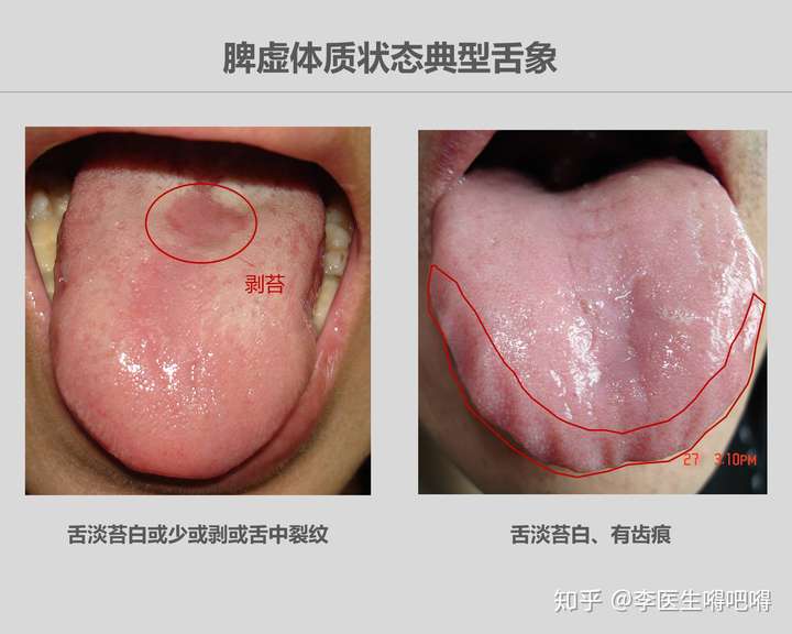 花剥苔怎么治疗图片