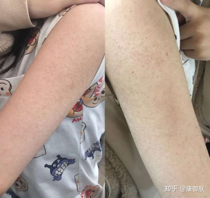 为什么过敏后会变成鸡皮肤(皮肤过敏后变鸡皮皮肤怎么办)