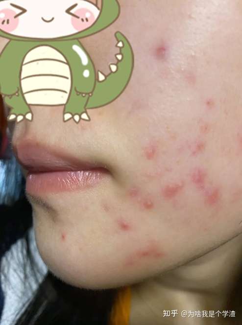我脸上的红色痘印七八个月了,一直不下去,我该怎么办