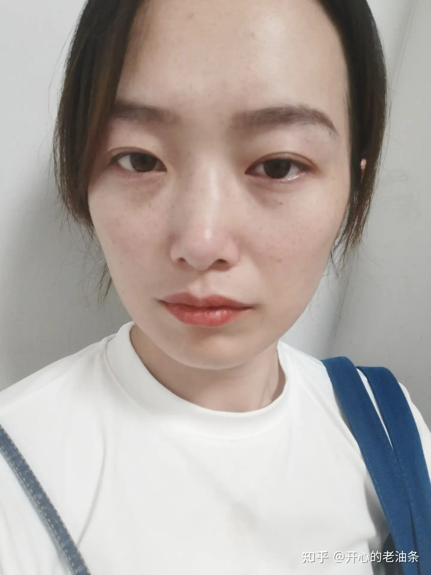 鼻骨骨折医生不建议手术 但是鼻子有凸起怎么办 手术花费多少 手术需要人陪吗 知乎