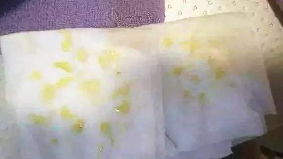 乳汁在乳房里会导致乳腺增生,乳腺癌吗?