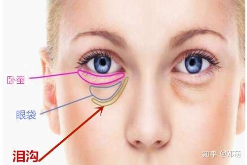 根据你的照片看是泪沟