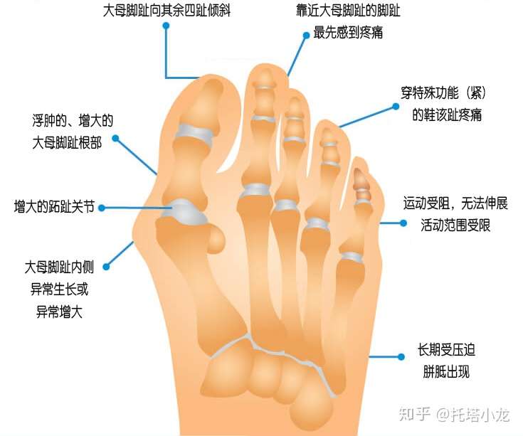 拇囊炎 拇外翻怎么办 知乎 拇囊炎 拇外翻怎么办 知乎