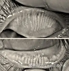 蠕形螨睑缘炎物理治疗