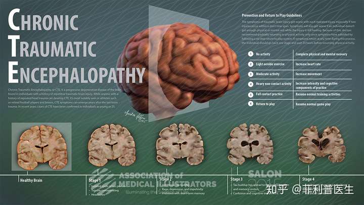 变傻,因为人的头部如果经常受到撞击会对大脑造成不断累积的微小损伤