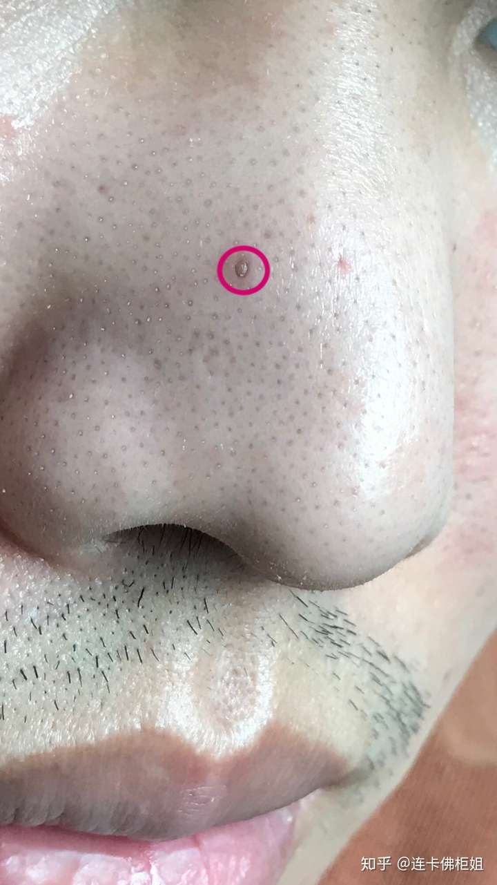 请问鼻子上这种大黑头该怎么处理