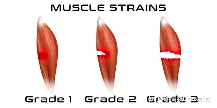 什么程度算肌肉酸痛而什么程度算肌肉拉伤