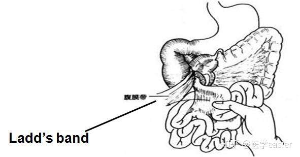会的 肠扭转就类似于打结,如果不及时复位还会发生肠道缺血,坏死,穿孔