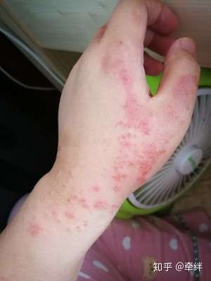 手背后背一直起鸡皮疙瘩(手背上出的像鸡皮一样的疙瘩有点痒)