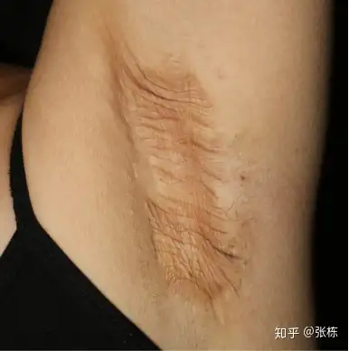 腋窝大汗腺分布在距离皮肤2m