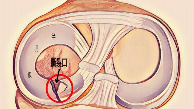 磁共振报告提示半月板损伤并不代表你半月板真的有损伤