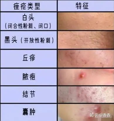 战痘第一步分清痤疮的6种基本类型