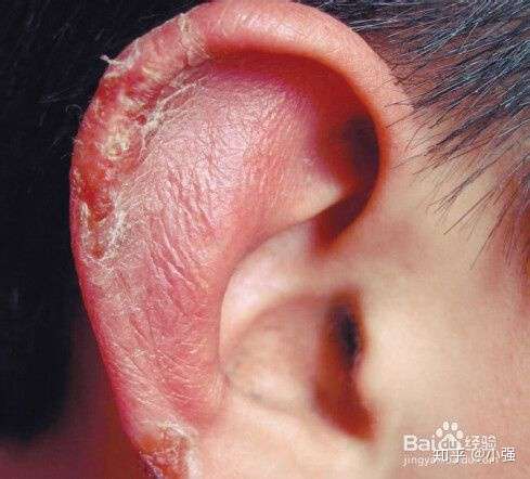 耳朵会冻掉么或者说这种说法存在与否