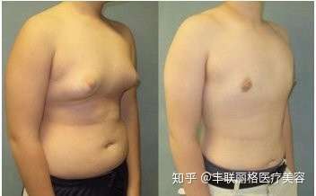 颜士钧医师 男生 胸大 的痛 也许只有他能懂 知乎