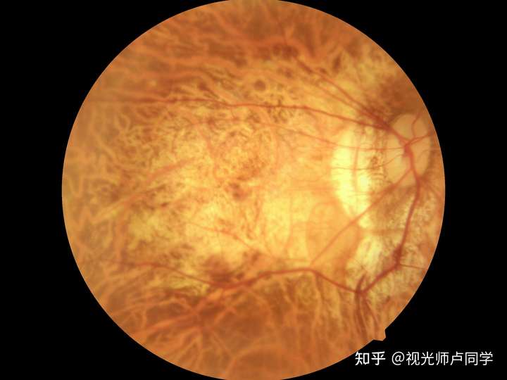 高度近视眼底视网膜也可观察到视乳头区旁的近视弧形斑,眼底豹纹状