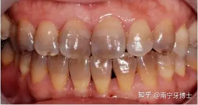 发黑的牙齿都是蛀牙吗? 