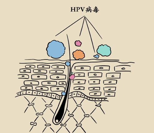 尖銳溼疣是怎麼得的