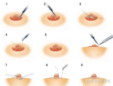 杭州做乳头凹陷矫正手术哪个医院好?