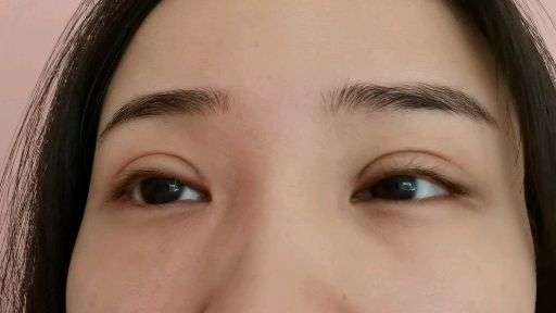 双眼皮术后14天,眼头分叉,我这是不是增生了?