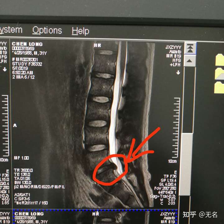 看了好多知乎网友的回答有的腰间盘突出比我还严重的还能坚持工作你们