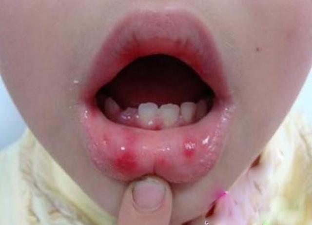 六岁的小孩经常口腔溃疡有什么办法吗