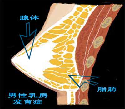 男性乳房發育切除手術後,引發乳頭長期凹陷的概率會有多大呢?