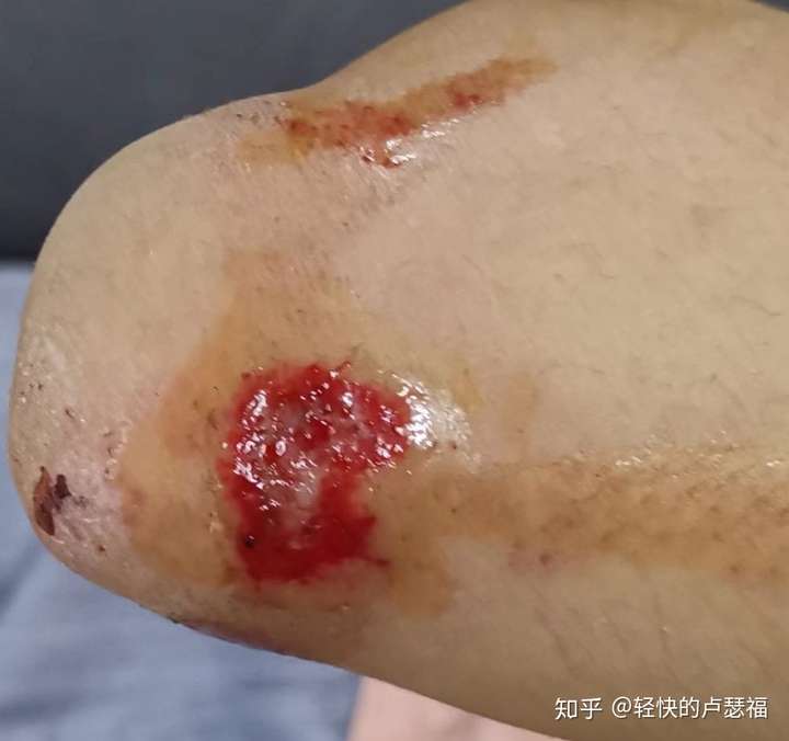 玩滑板摔倒是一种怎样的体验