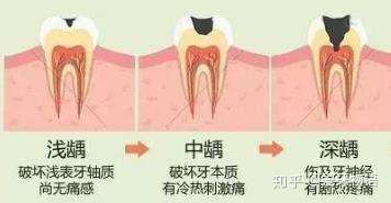 牙齿矫正容易得蛀牙 这是真的吗 知乎