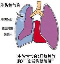 咳嗽,屏氣,舉重運動,用力排便,情緒激動(吵架)等損傷髒層胸膜而引發