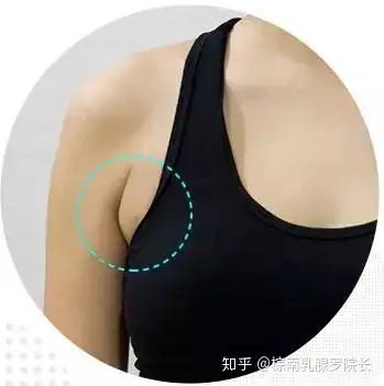 你有腋下副乳吗