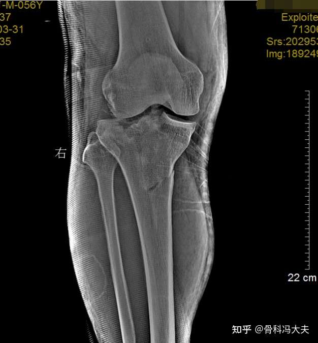 胫骨平台骨折 如何正确判断 正确决断 知乎