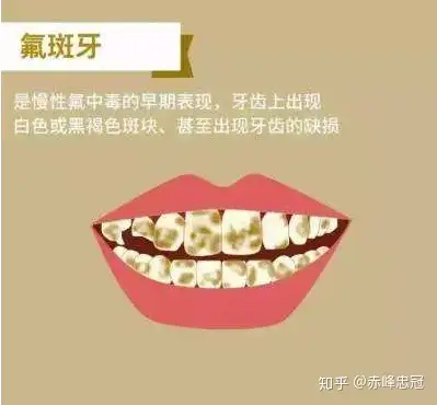 氟斑牙做冷光美白可以消除吗?还是说必须做贴面?